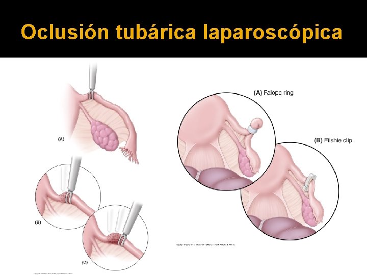 Oclusión tubárica laparoscópica 