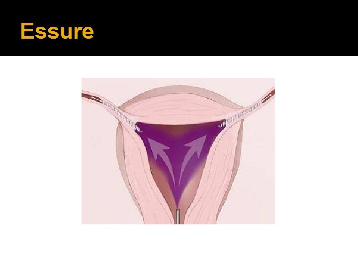 Essure 