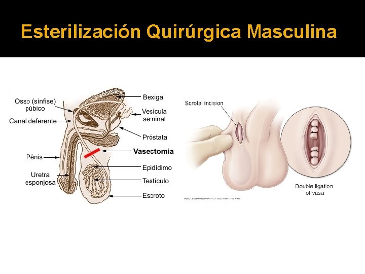 Esterilización Quirúrgica Masculina 