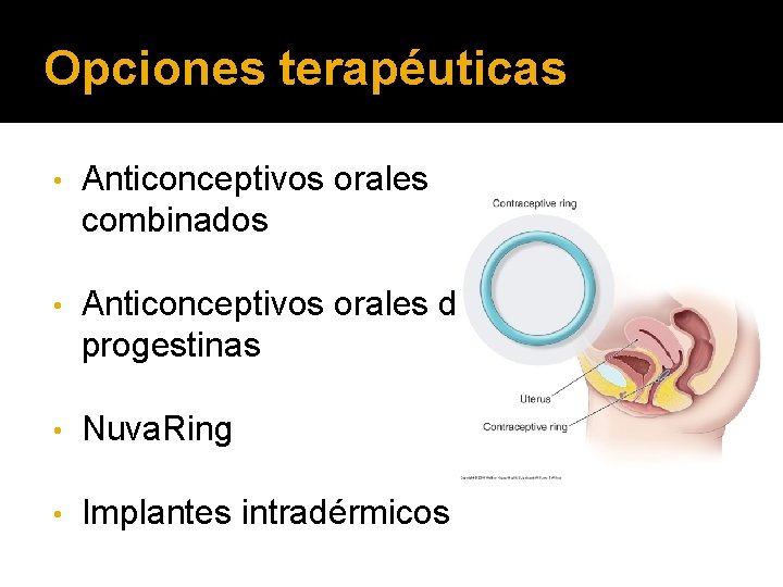 Opciones terapéuticas • Anticonceptivos orales combinados • Anticonceptivos orales de progestinas • Nuva. Ring
