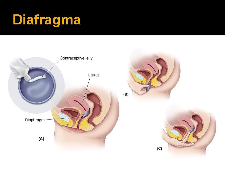 Diafragma 