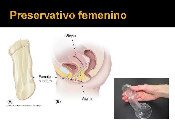 Preservativo femenino 