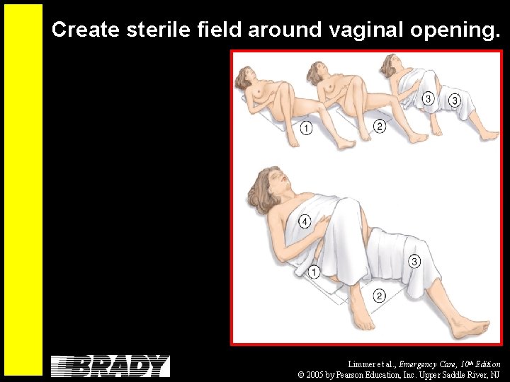 Create sterile field around vaginal opening. Limmer et al. , Emergency Care, 10 th