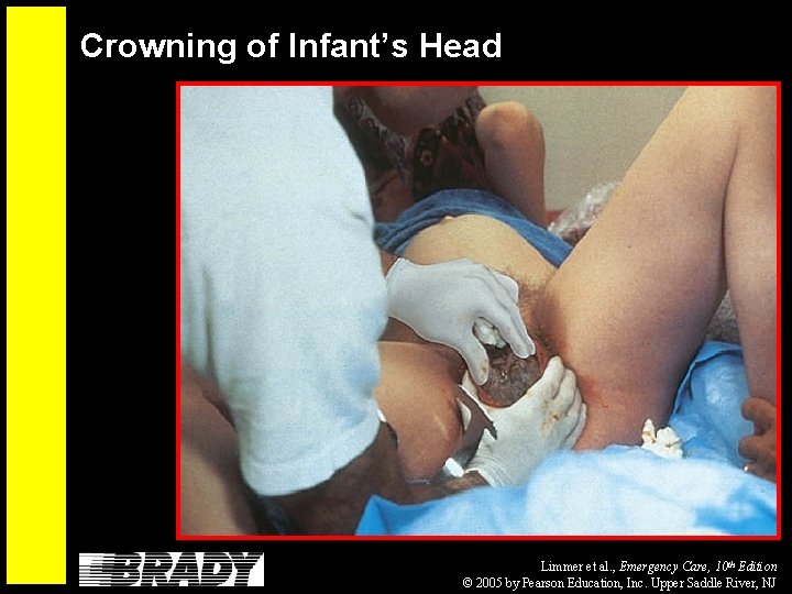 Crowning of Infant’s Head Limmer et al. , Emergency Care, 10 th Edition ©