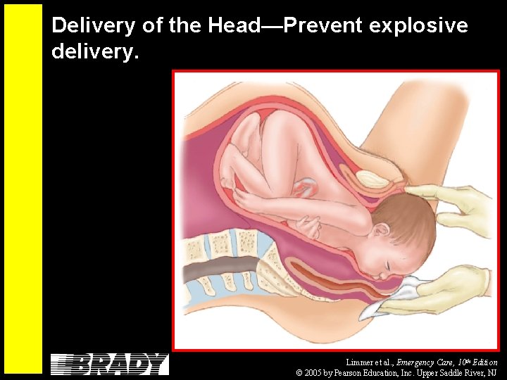 Delivery of the Head—Prevent explosive delivery. Limmer et al. , Emergency Care, 10 th