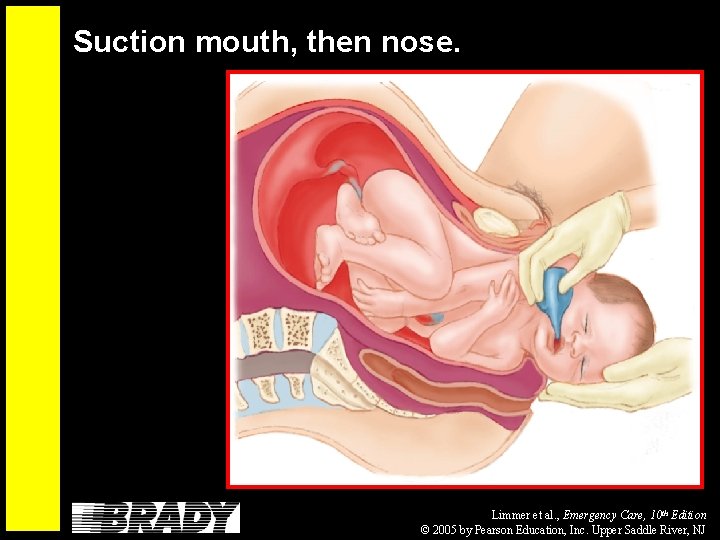 Suction mouth, then nose. Limmer et al. , Emergency Care, 10 th Edition ©