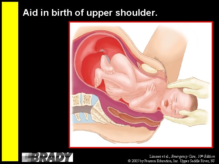 Aid in birth of upper shoulder. Limmer et al. , Emergency Care, 10 th