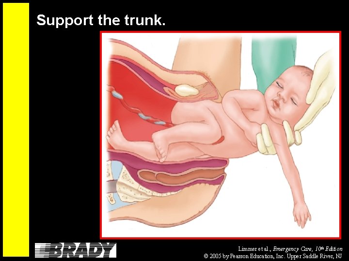 Support the trunk. Limmer et al. , Emergency Care, 10 th Edition © 2005