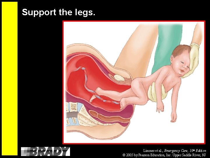 Support the legs. Limmer et al. , Emergency Care, 10 th Edition © 2005