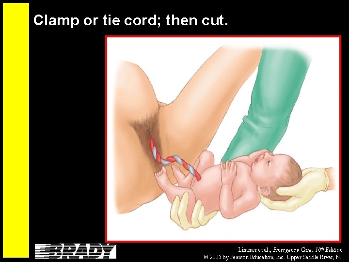 Clamp or tie cord; then cut. Limmer et al. , Emergency Care, 10 th