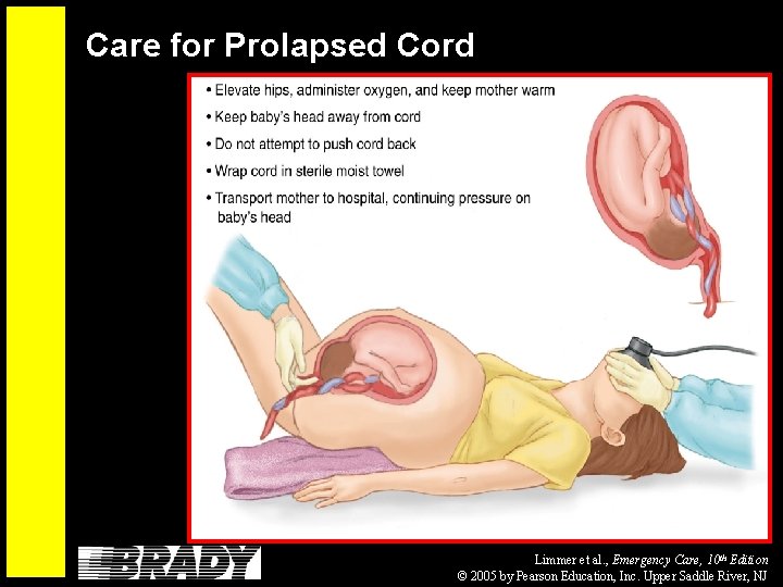 Care for Prolapsed Cord Limmer et al. , Emergency Care, 10 th Edition ©