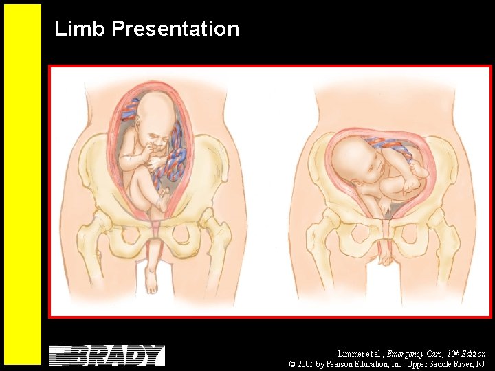 Limb Presentation Limmer et al. , Emergency Care, 10 th Edition © 2005 by