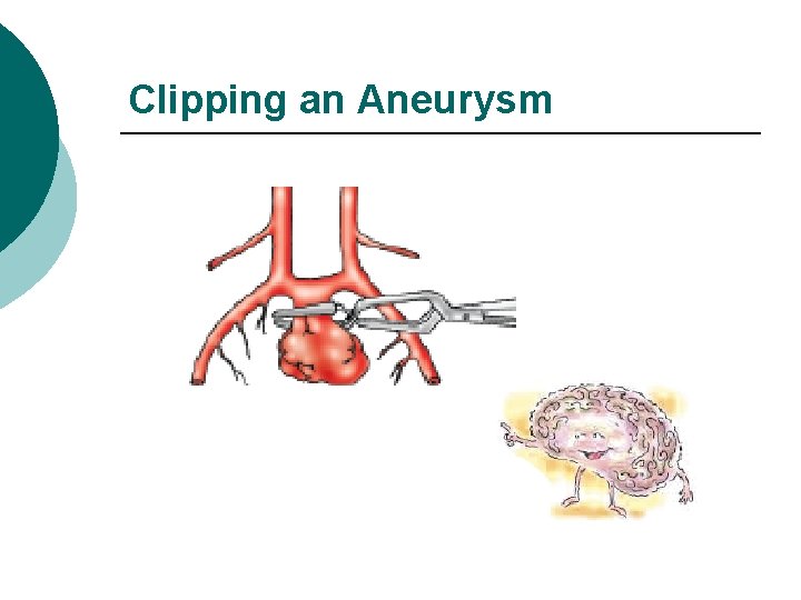 Clipping an Aneurysm 