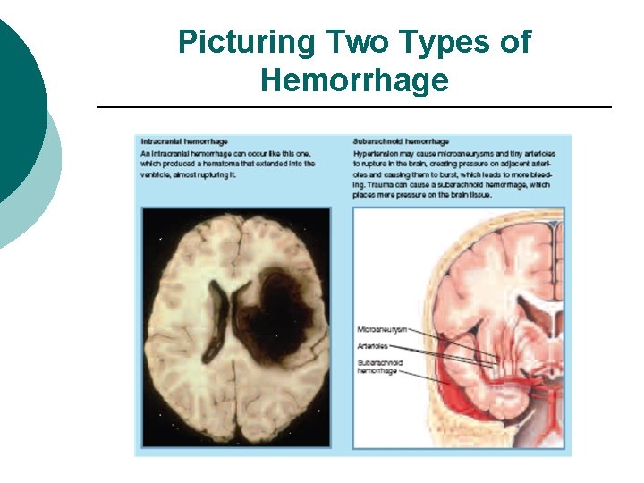 Picturing Two Types of Hemorrhage 