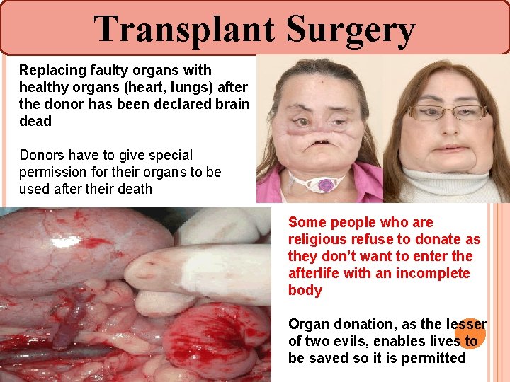 Transplant Surgery Replacing faulty organs with healthy organs (heart, lungs) after the donor has