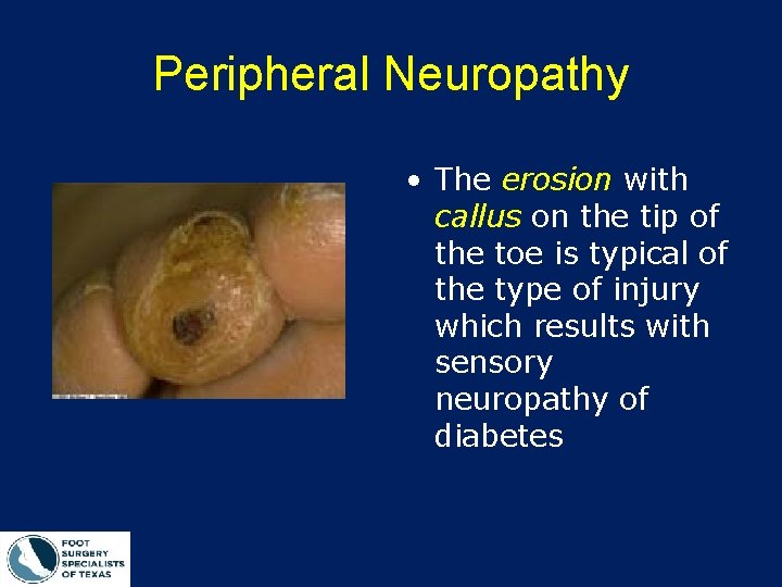 Peripheral Neuropathy • The erosion with callus on the tip of the toe is