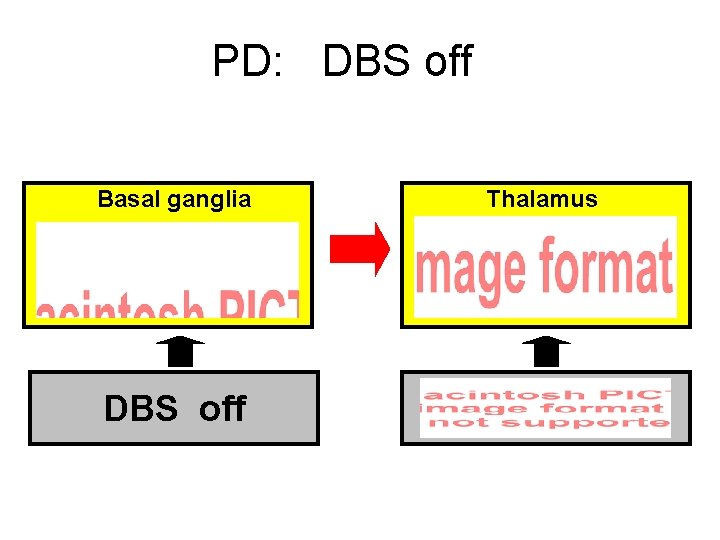 PD: DBS off Basal ganglia DBS off Thalamus 