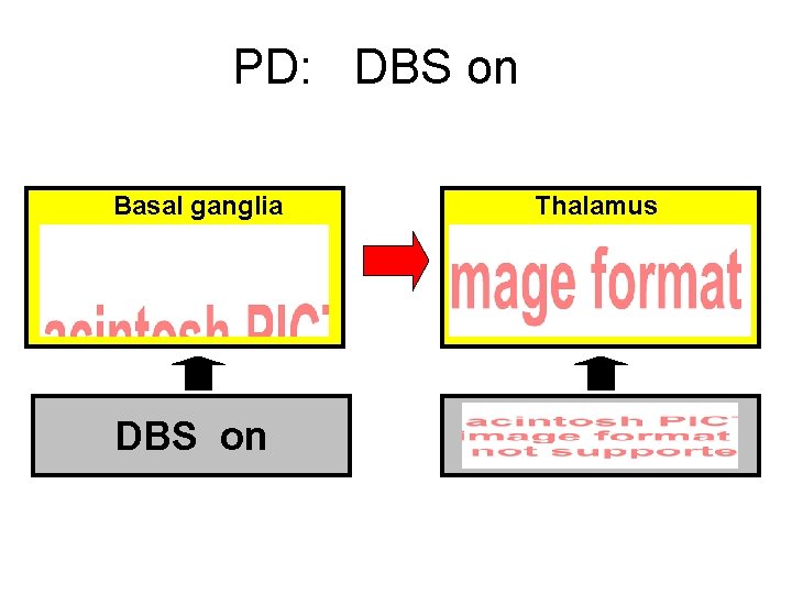 PD: DBS on Basal ganglia DBS on Thalamus 