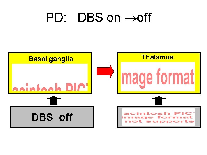 PD: DBS on off Basal ganglia DBS off Thalamus 