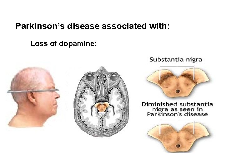 Parkinson’s disease associated with: Loss of dopamine: 