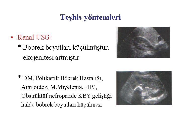 Teşhis yöntemleri • Renal USG: * Böbrek boyutları küçülmüştür. ekojenitesi artmıştır. * DM, Polikistik