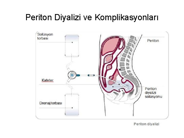 Periton Diyalizi ve Komplikasyonları 