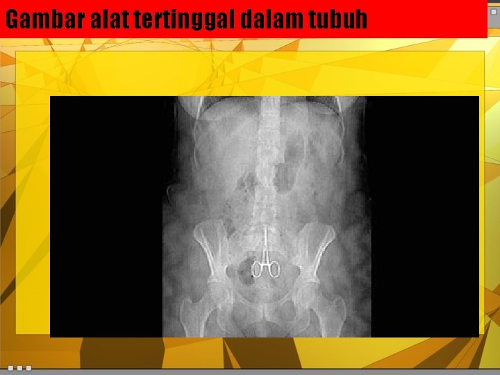 Gambar alat tertinggal dalam tubuh 