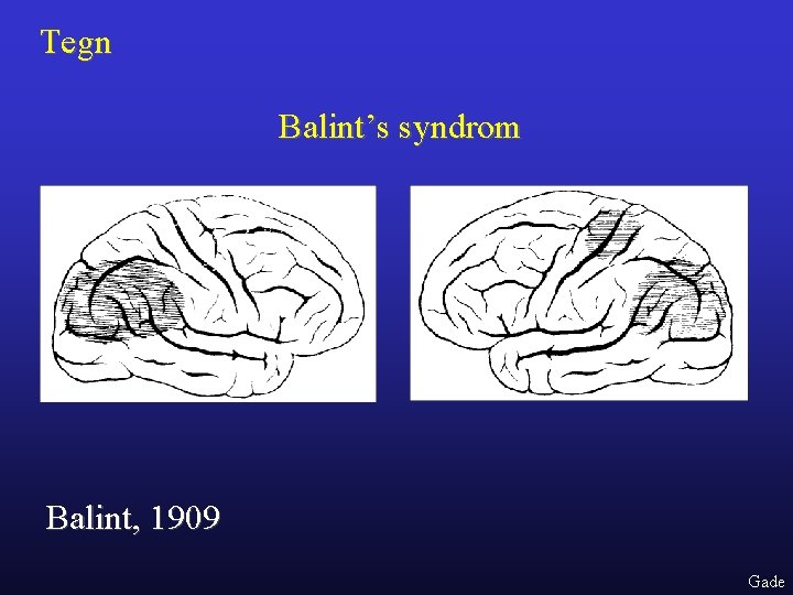 Tegn Balint’s syndrom Balint, 1909 Gade 