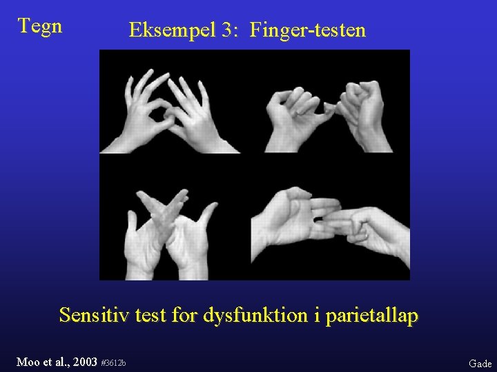 Tegn Eksempel 3: Finger-testen Sensitiv test for dysfunktion i parietallap Moo et al. ,