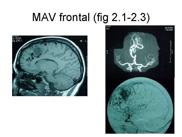 MAV frontal (fig 2. 1 -2. 3) 