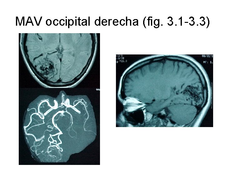 MAV occipital derecha (fig. 3. 1 -3. 3) 