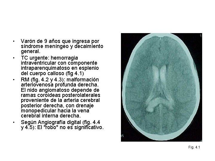  • • Varón de 9 años que ingresa por síndrome meníngeo y decaimiento