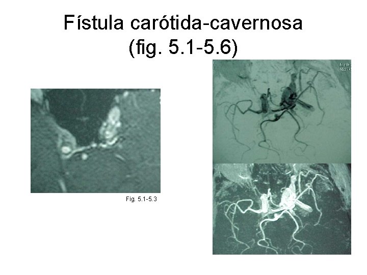 Fístula carótida-cavernosa (fig. 5. 1 -5. 6) Fig. 5. 1 -5. 3 