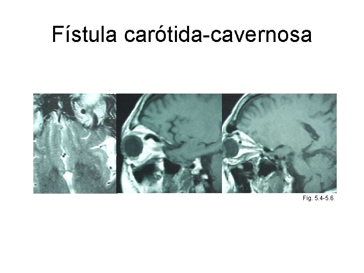 Fístula carótida-cavernosa Fig. 5. 4 -5. 6 