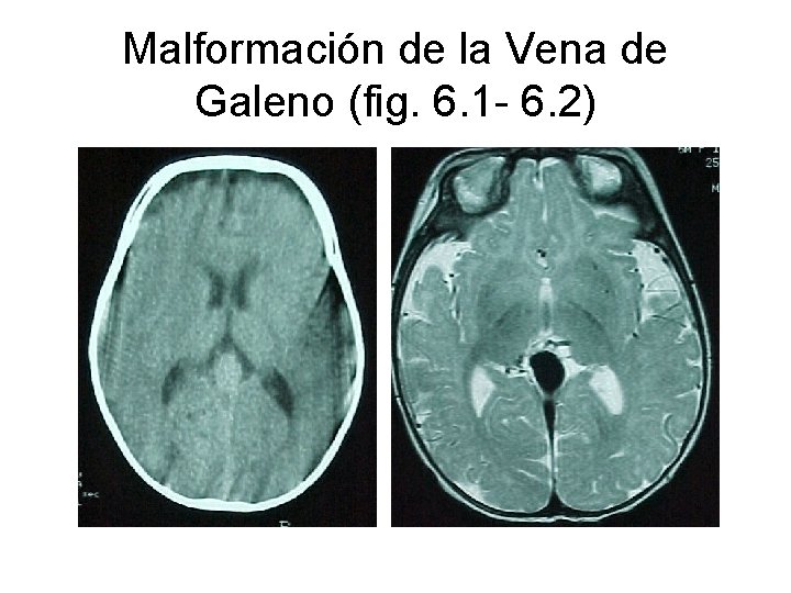Malformación de la Vena de Galeno (fig. 6. 1 - 6. 2) 