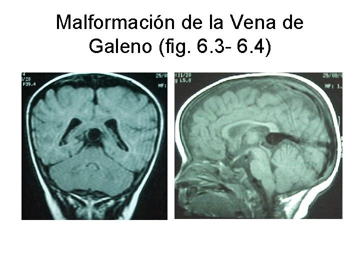 Malformación de la Vena de Galeno (fig. 6. 3 - 6. 4) 