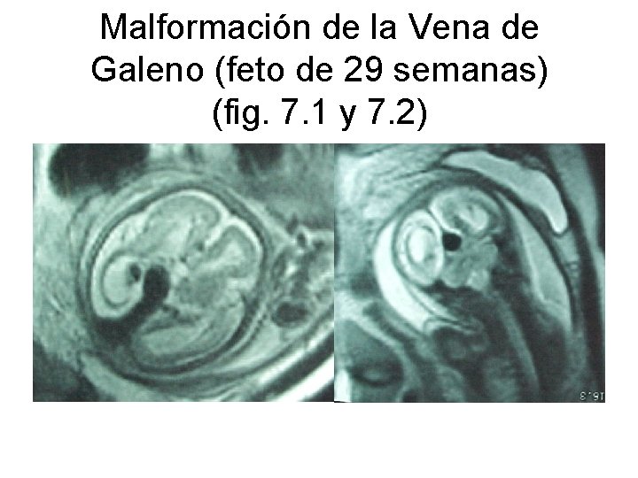 Malformación de la Vena de Galeno (feto de 29 semanas) (fig. 7. 1 y