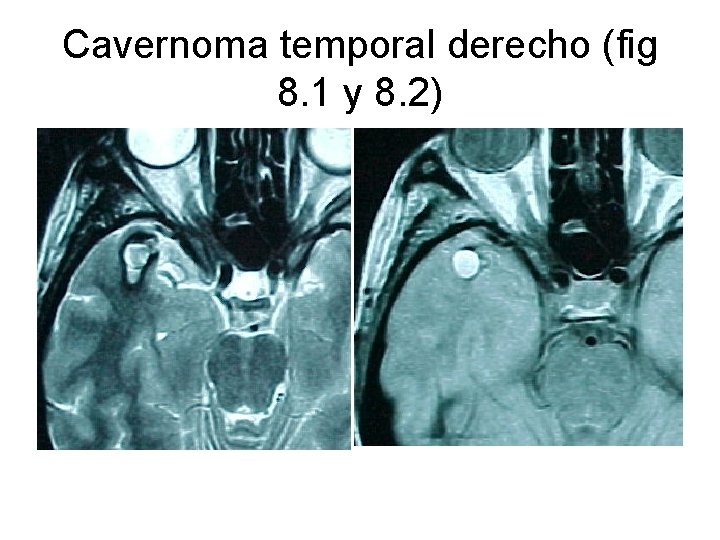 Cavernoma temporal derecho (fig 8. 1 y 8. 2) 