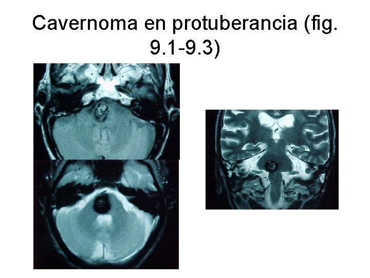 Cavernoma en protuberancia (fig. 9. 1 -9. 3) 