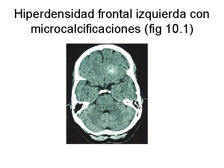 Hiperdensidad frontal izquierda con microcalcificaciones (fig 10. 1) 