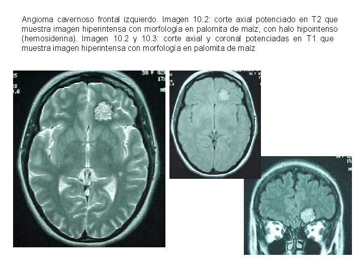 Angioma cavernoso frontal izquierdo. Imagen 10. 2: corte axial potenciado en T 2 que