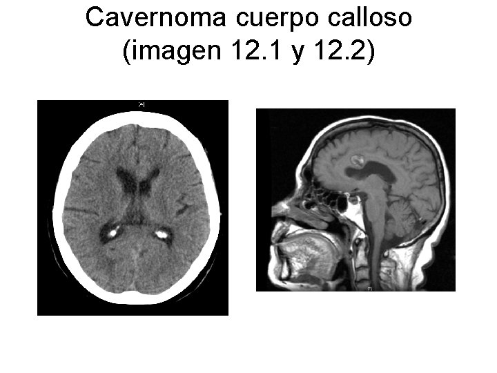 Cavernoma cuerpo calloso (imagen 12. 1 y 12. 2) 