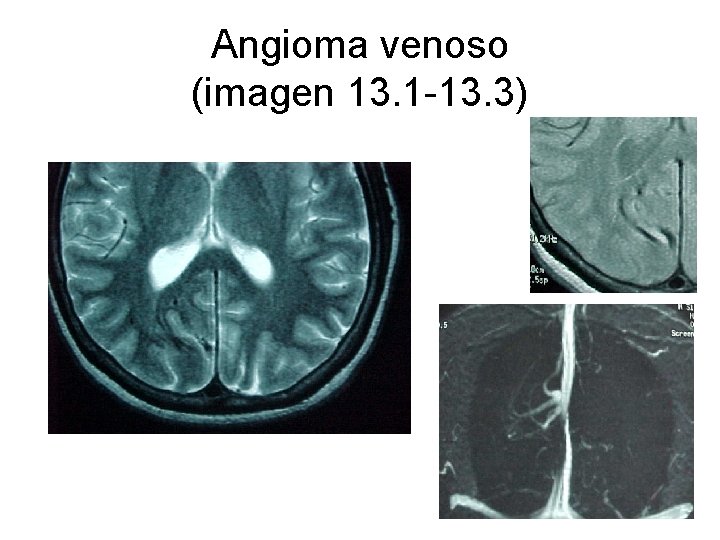 Angioma venoso (imagen 13. 1 -13. 3) 