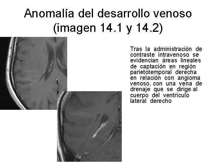 Anomalía del desarrollo venoso (imagen 14. 1 y 14. 2) Tras la administración de