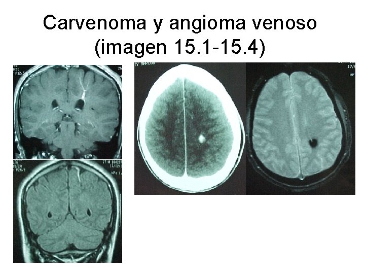 Carvenoma y angioma venoso (imagen 15. 1 -15. 4) 