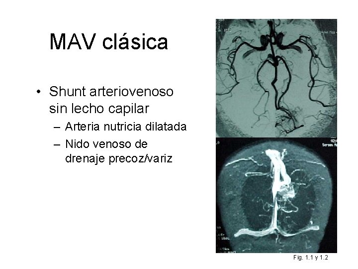 MAV clásica • Shunt arteriovenoso sin lecho capilar – Arteria nutricia dilatada – Nido