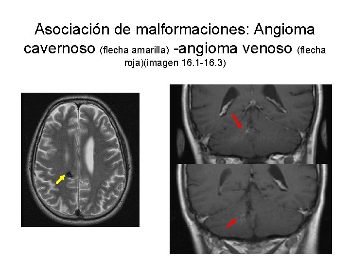 Asociación de malformaciones: Angioma cavernoso (flecha amarilla) -angioma venoso (flecha roja)(imagen 16. 1 -16.