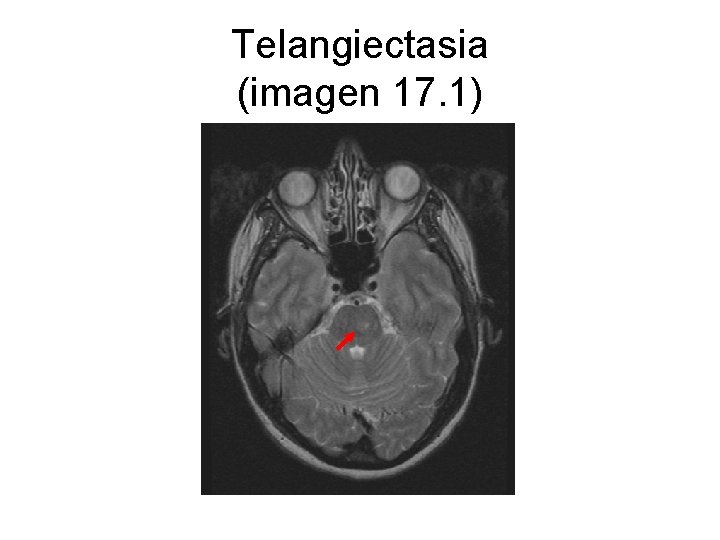 Telangiectasia (imagen 17. 1) 