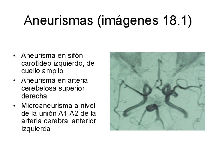 Aneurismas (imágenes 18. 1) • Aneurisma en sifón carotídeo izquierdo, de cuello amplio •