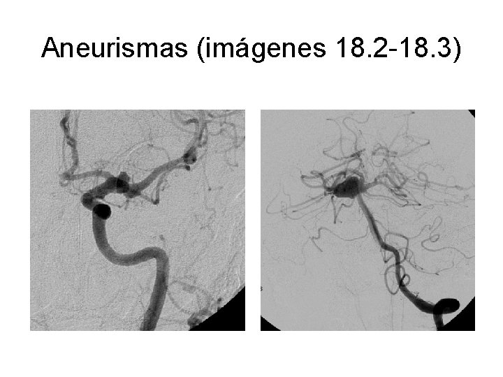 Aneurismas (imágenes 18. 2 -18. 3) 